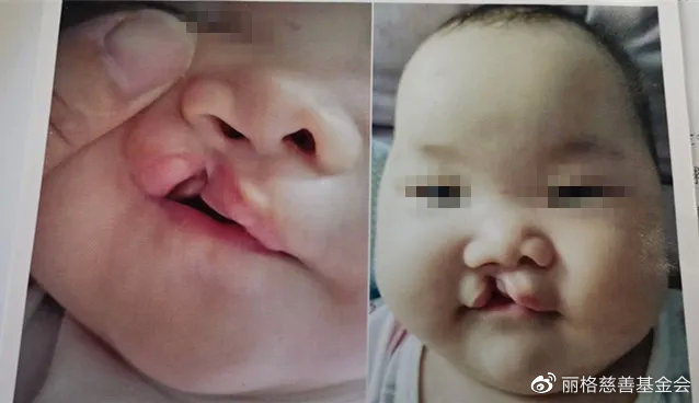 琪琪第一期唇腭裂术前照